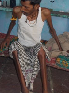 Worker Suffering from Silicosis